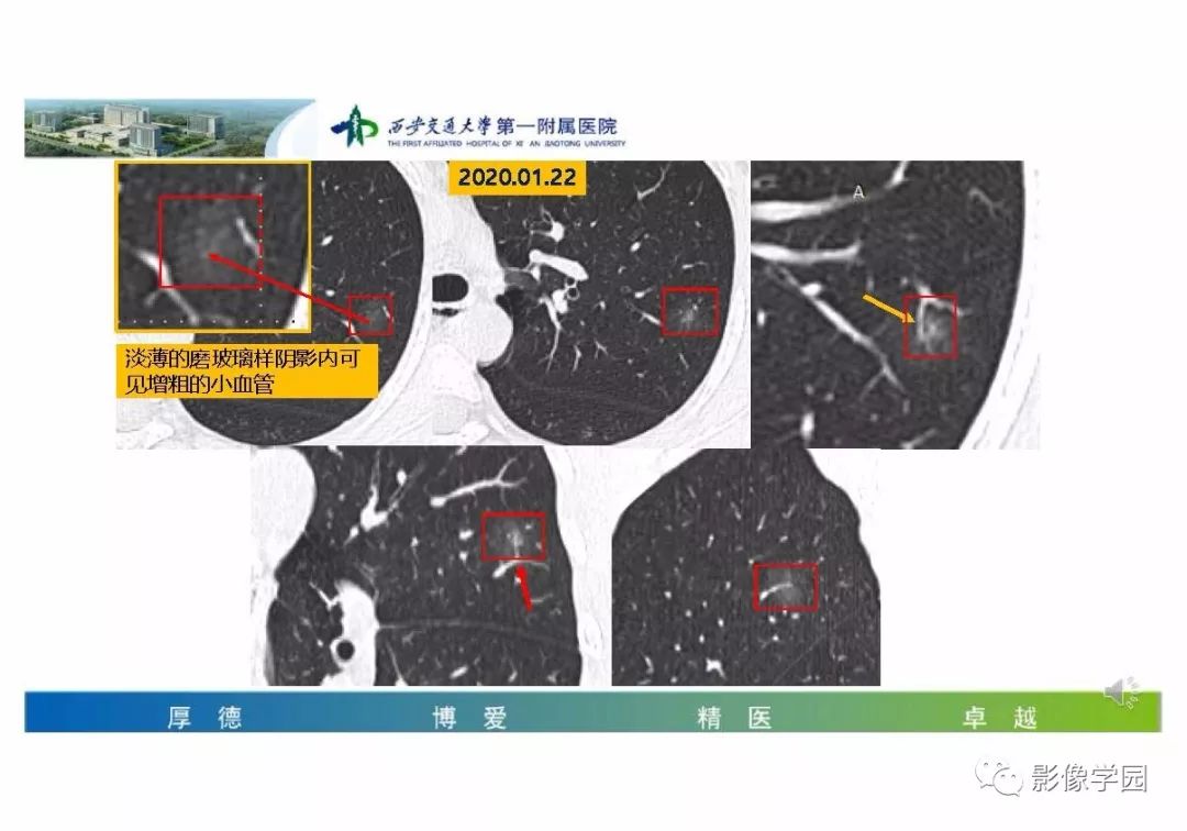 【PPT】输入性新冠肺炎的影像学特点与识别