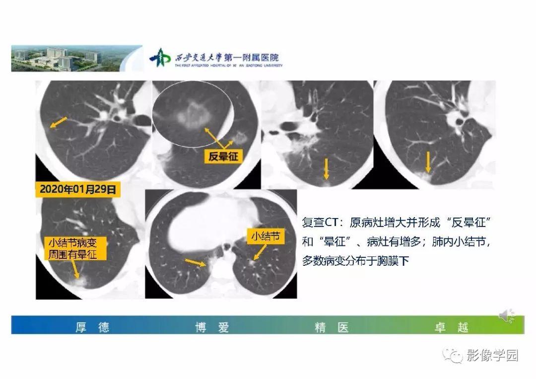 【PPT】输入性新冠肺炎的影像学特点与识别