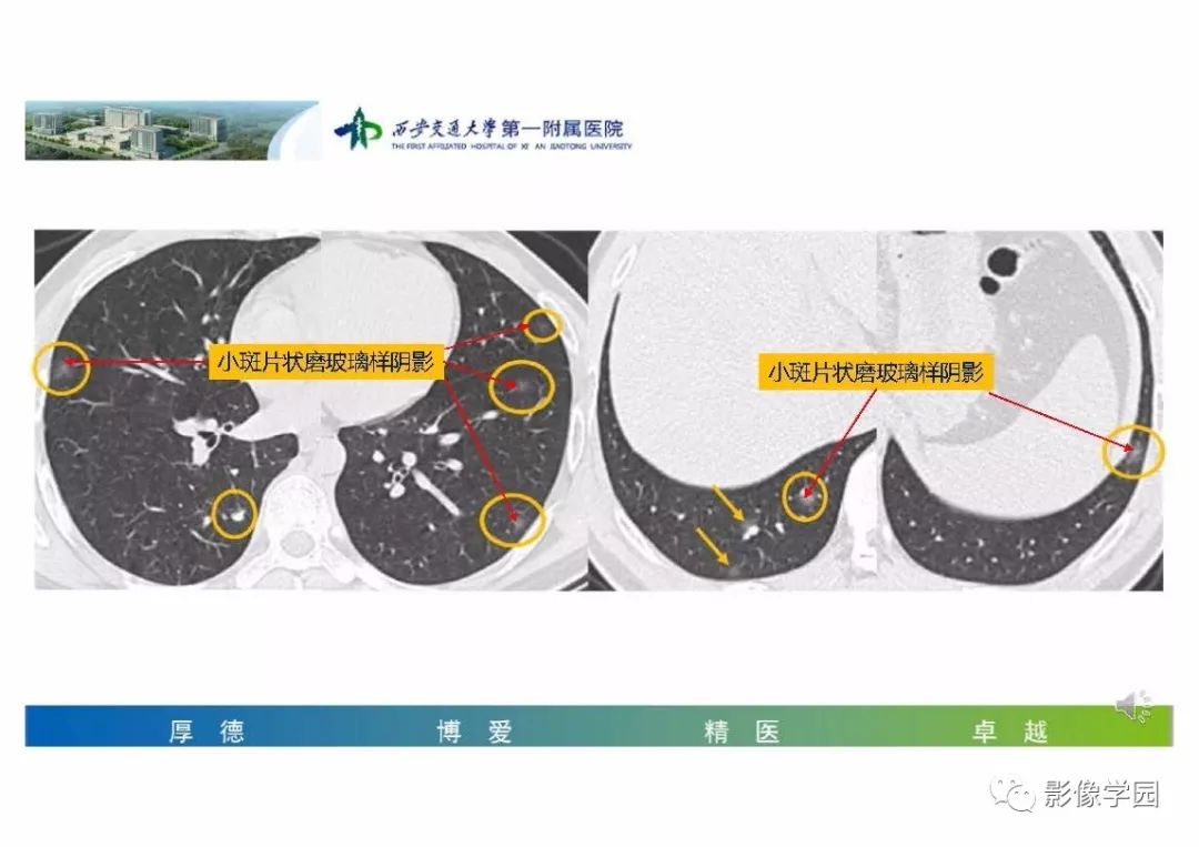 【PPT】输入性新冠肺炎的影像学特点与识别