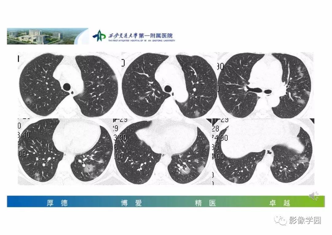 【PPT】输入性新冠肺炎的影像学特点与识别