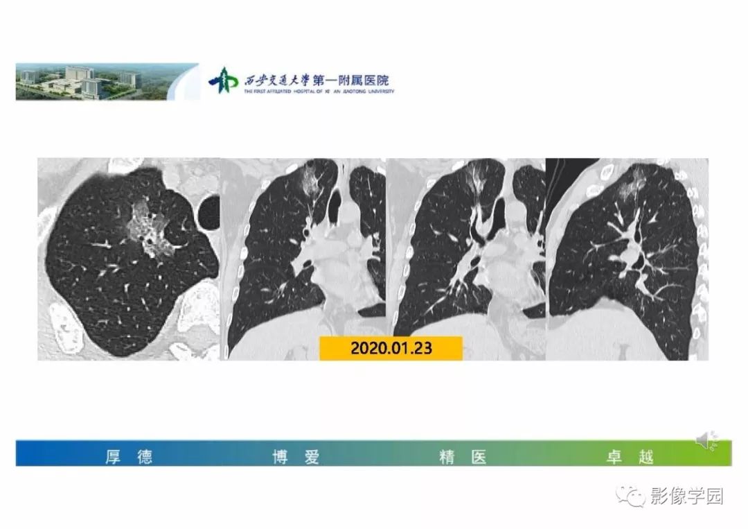 【PPT】输入性新冠肺炎的影像学特点与识别