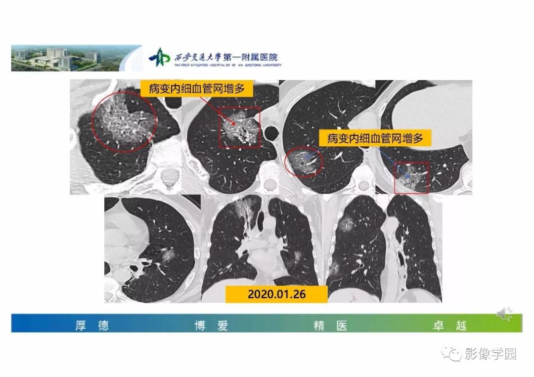 【PPT】输入性新冠肺炎的影像学特点与识别