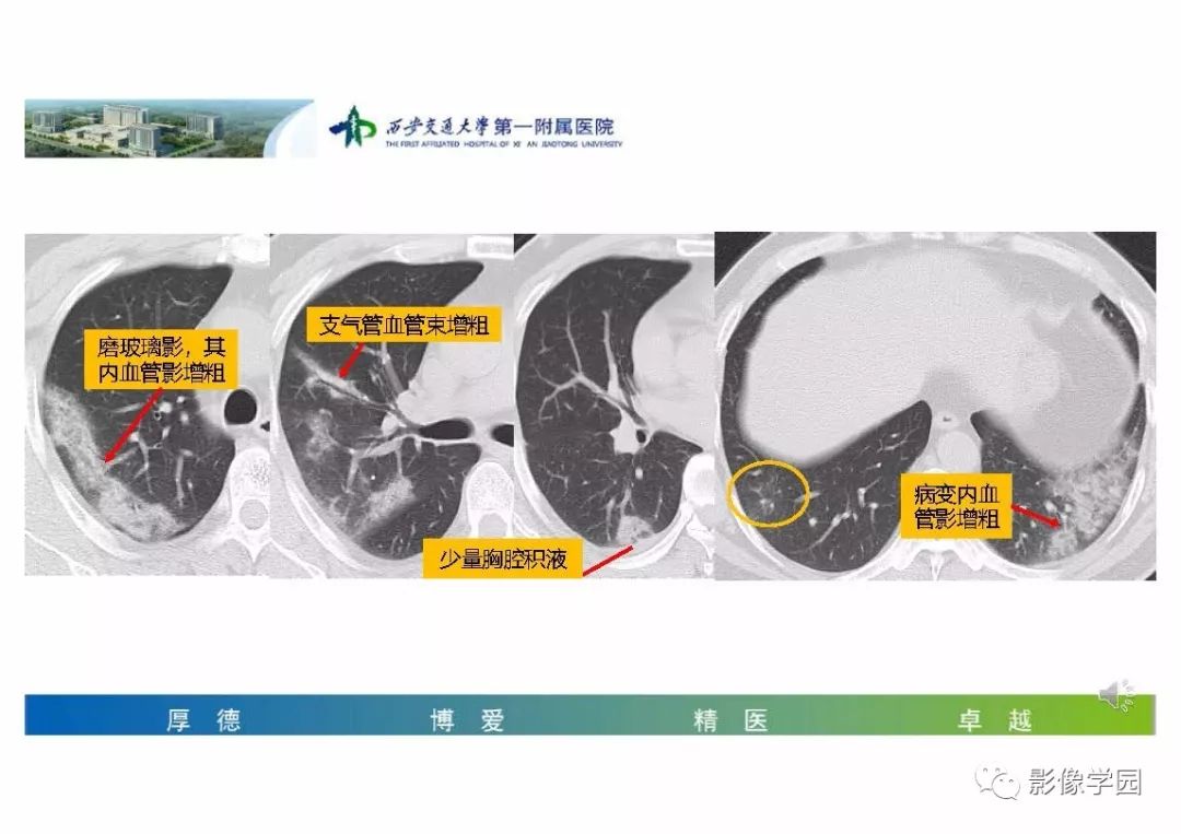 【PPT】输入性新冠肺炎的影像学特点与识别