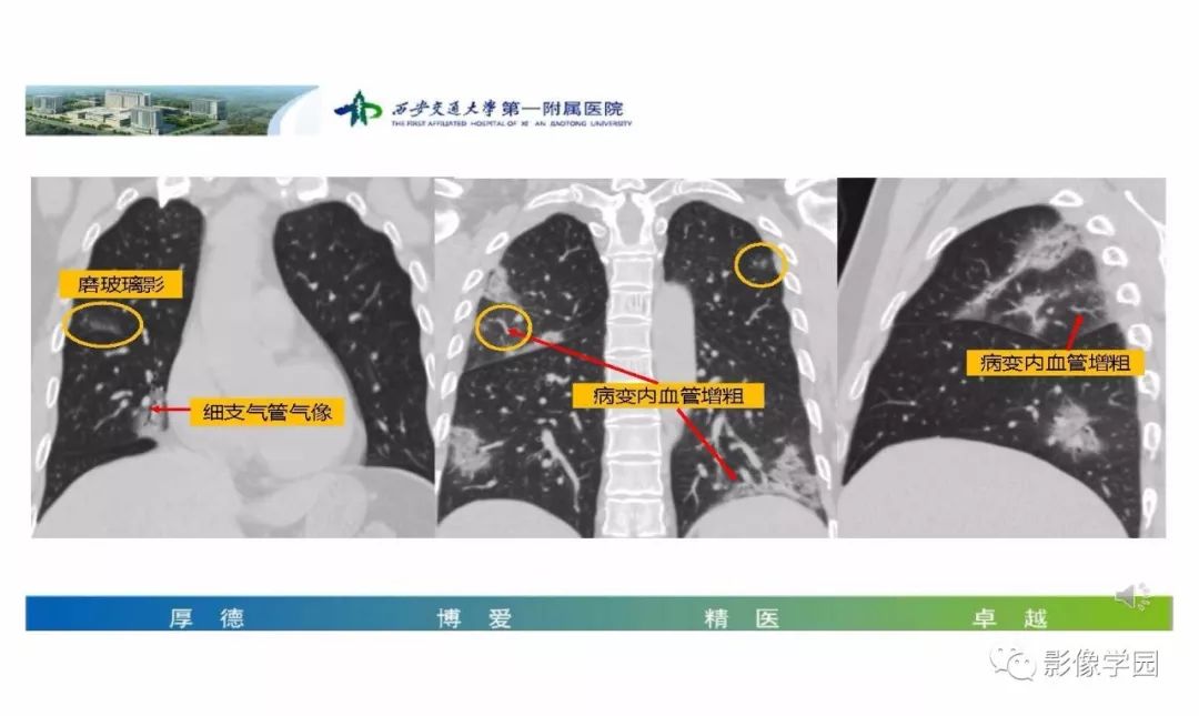 【PPT】输入性新冠肺炎的影像学特点与识别