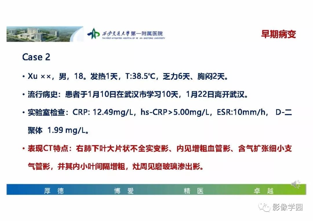 【PPT】输入性新冠肺炎的影像学特点与识别