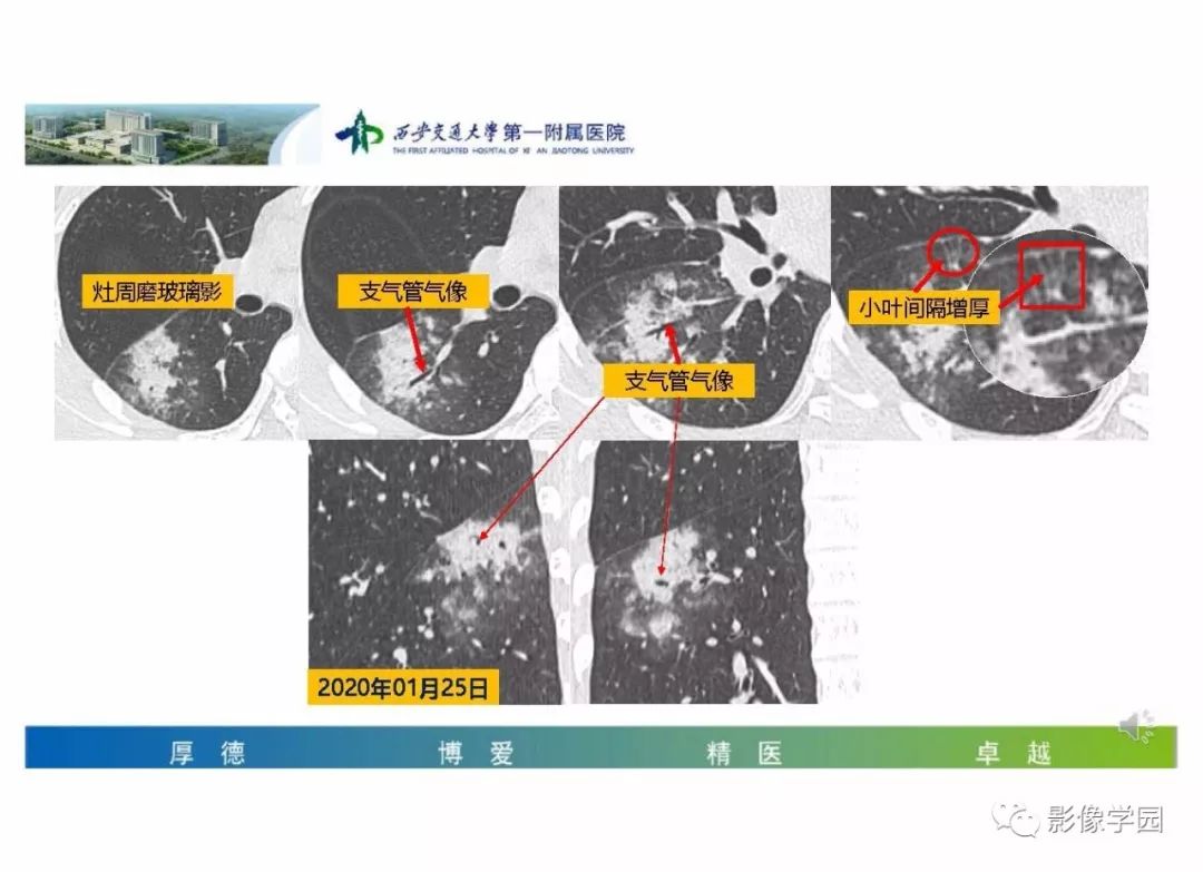 【PPT】输入性新冠肺炎的影像学特点与识别