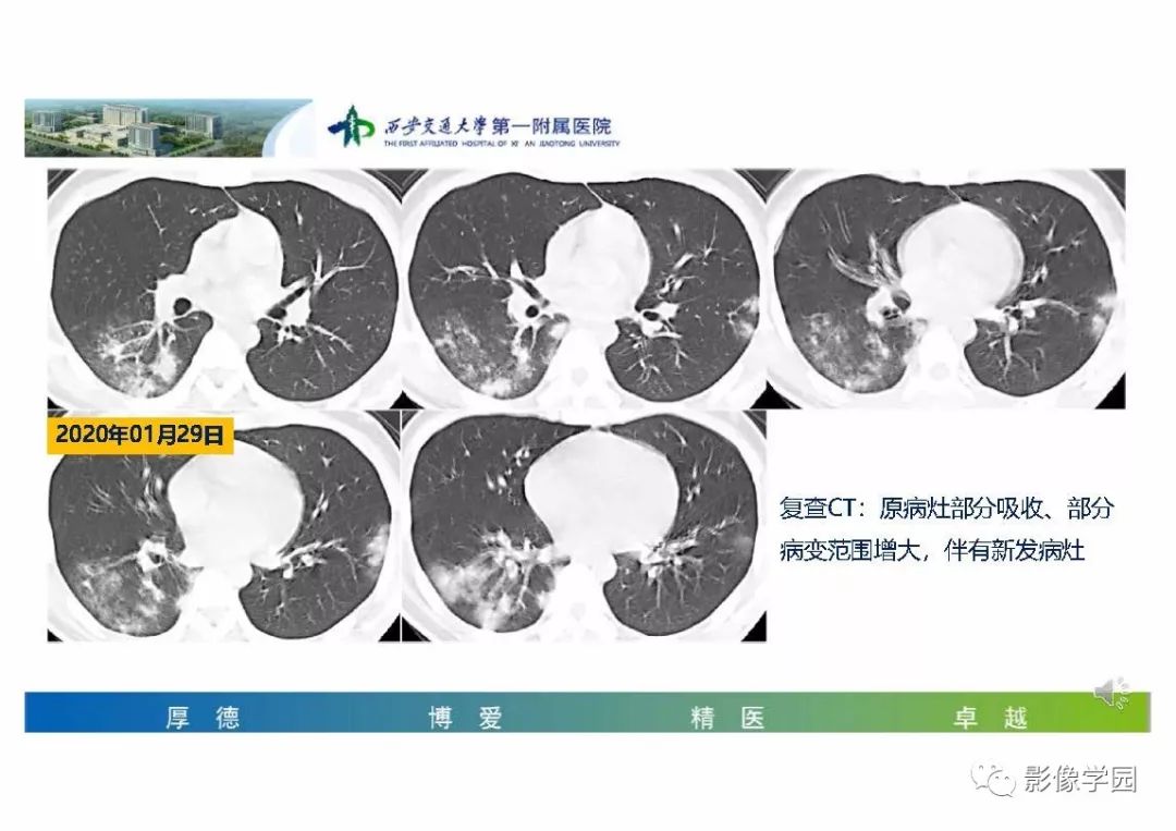 【PPT】输入性新冠肺炎的影像学特点与识别