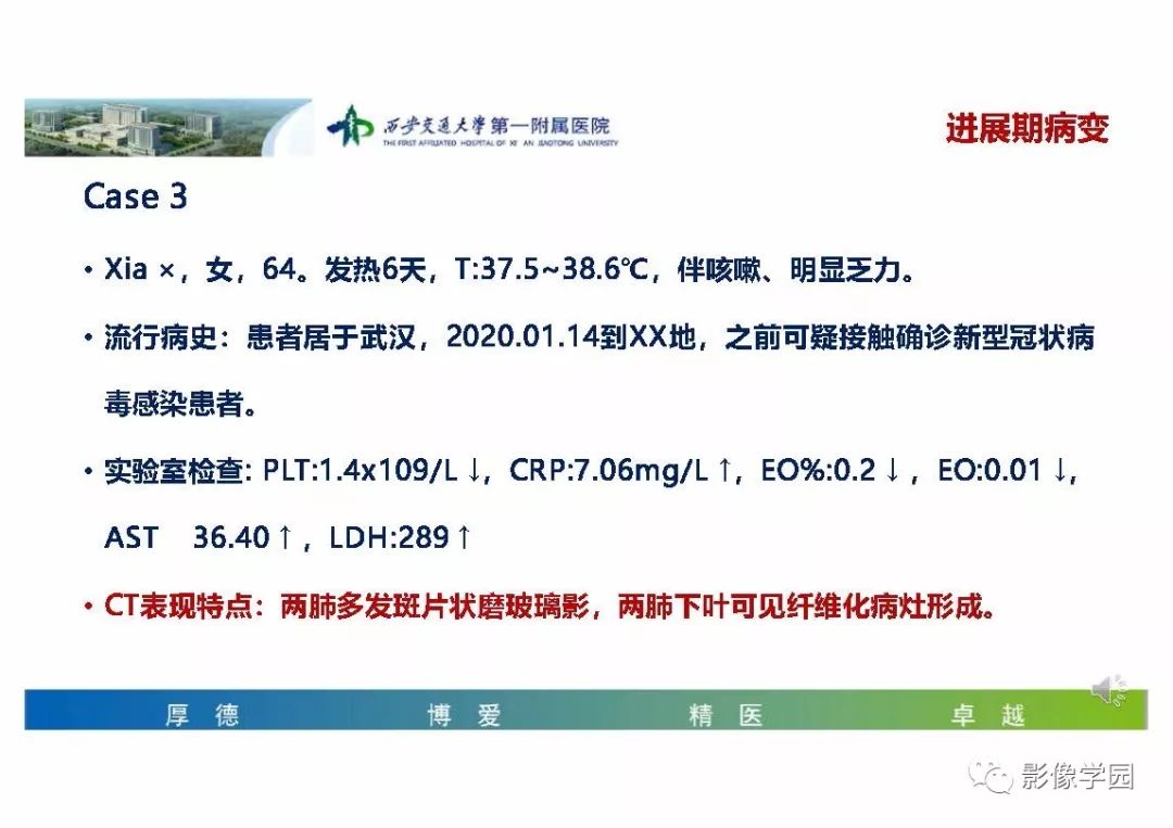 【PPT】输入性新冠肺炎的影像学特点与识别