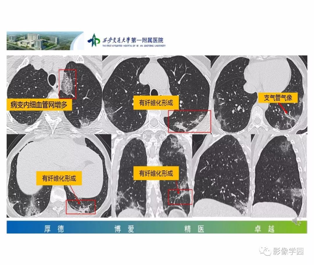 【PPT】输入性新冠肺炎的影像学特点与识别