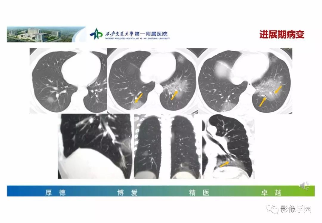 【PPT】输入性新冠肺炎的影像学特点与识别