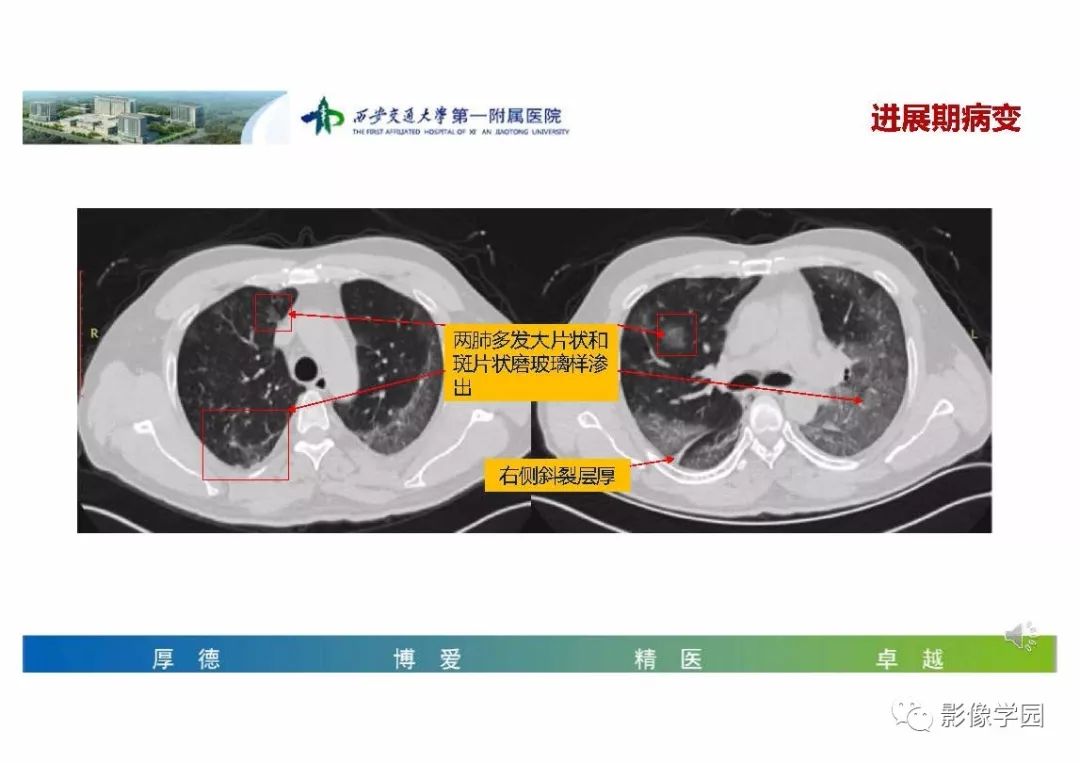 【PPT】输入性新冠肺炎的影像学特点与识别