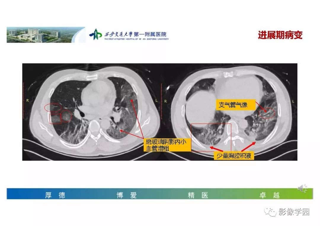 【PPT】输入性新冠肺炎的影像学特点与识别