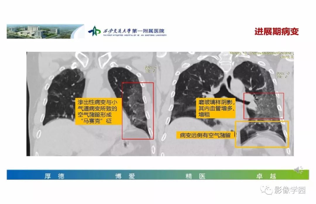 【PPT】输入性新冠肺炎的影像学特点与识别