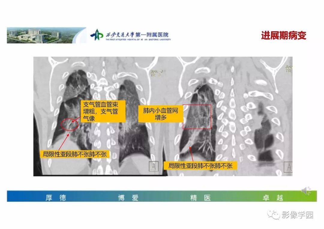 【PPT】输入性新冠肺炎的影像学特点与识别