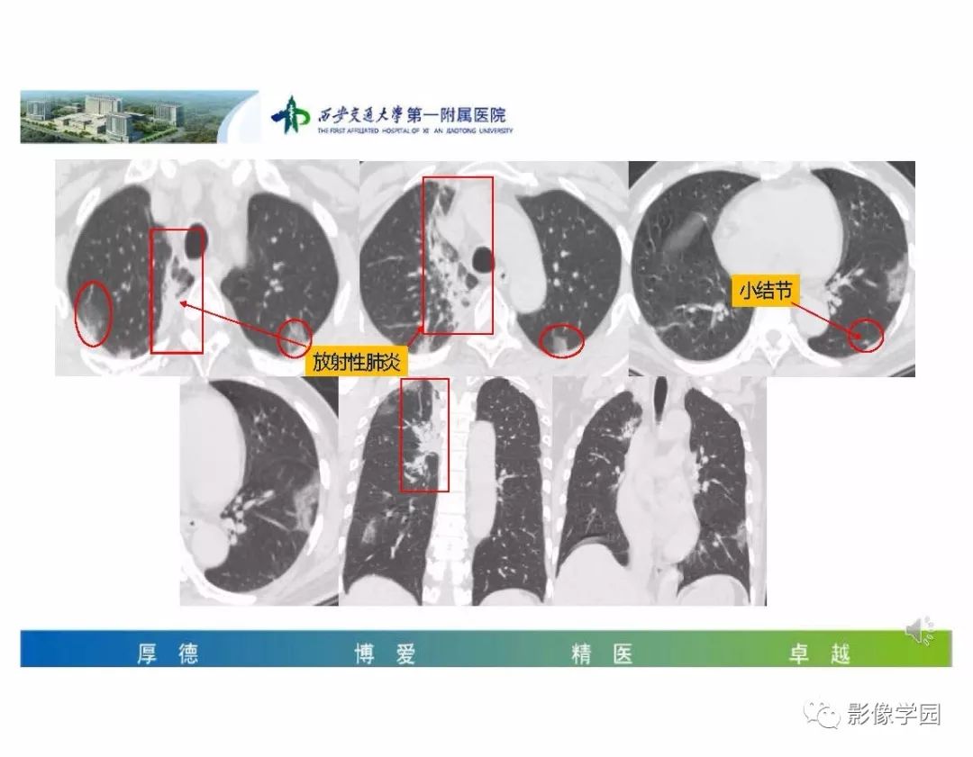 【PPT】输入性新冠肺炎的影像学特点与识别