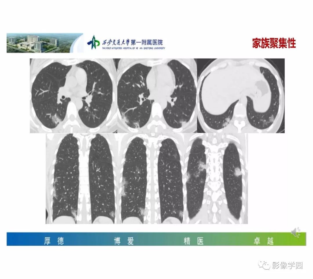 【PPT】输入性新冠肺炎的影像学特点与识别