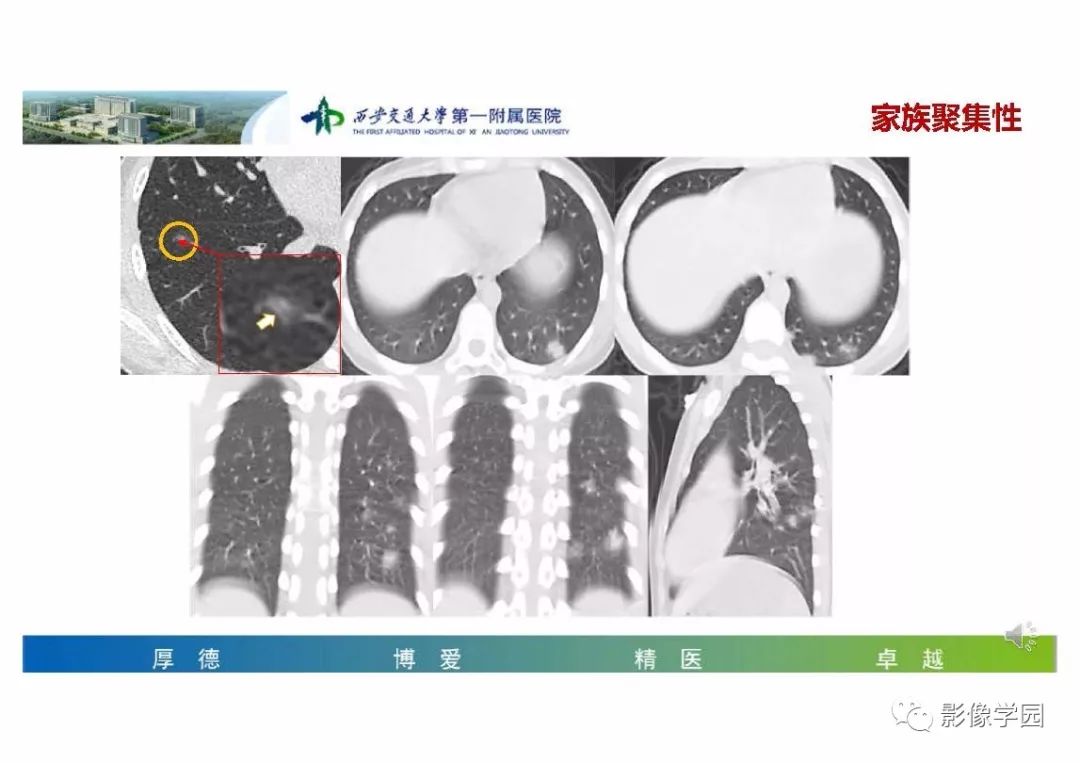 【PPT】输入性新冠肺炎的影像学特点与识别