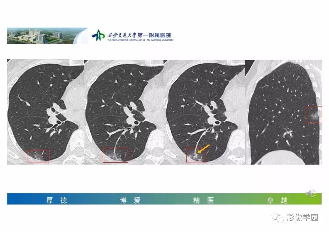 【PPT】输入性新冠肺炎的影像学特点与识别