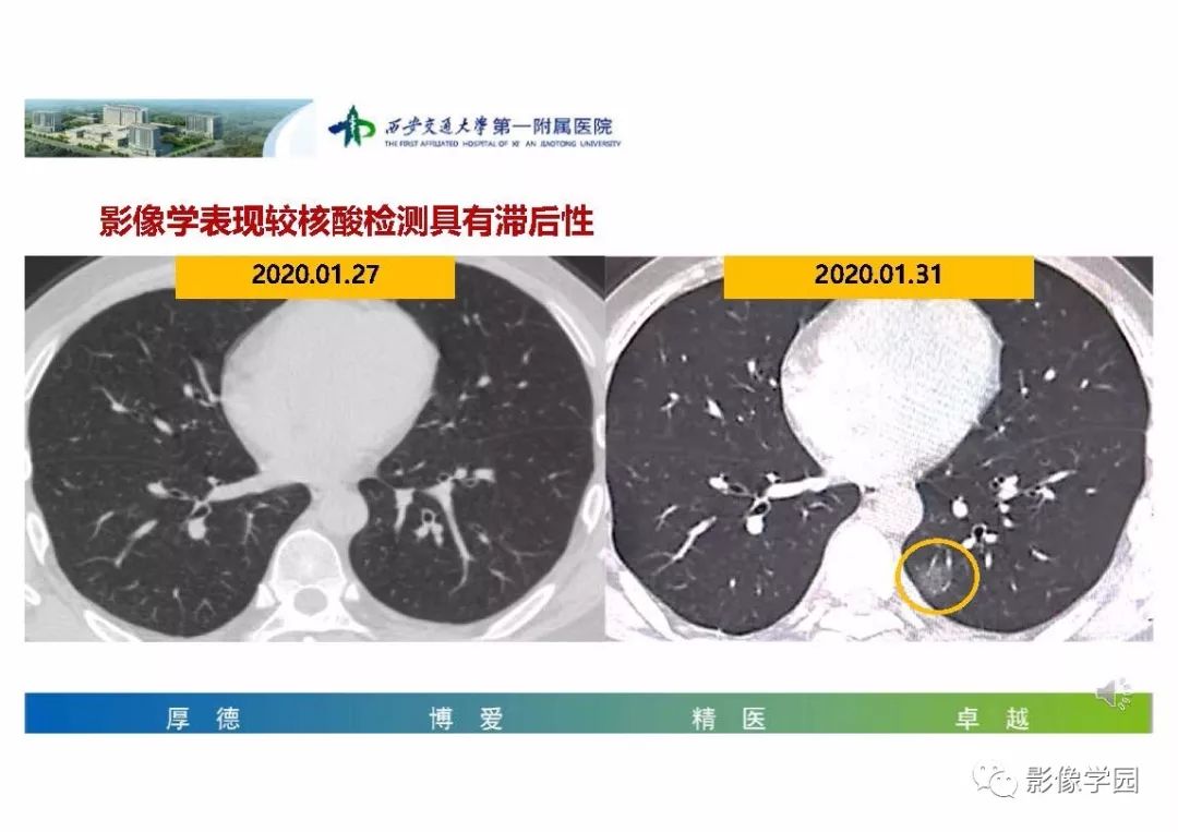 【PPT】输入性新冠肺炎的影像学特点与识别