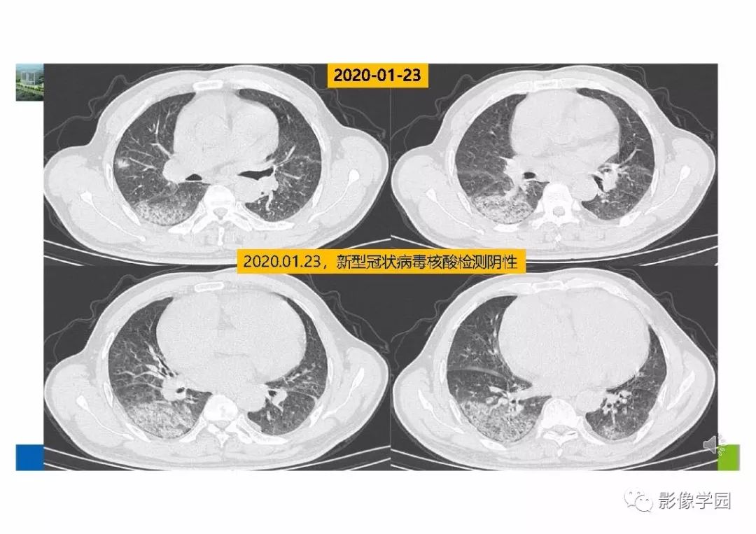 【PPT】输入性新冠肺炎的影像学特点与识别