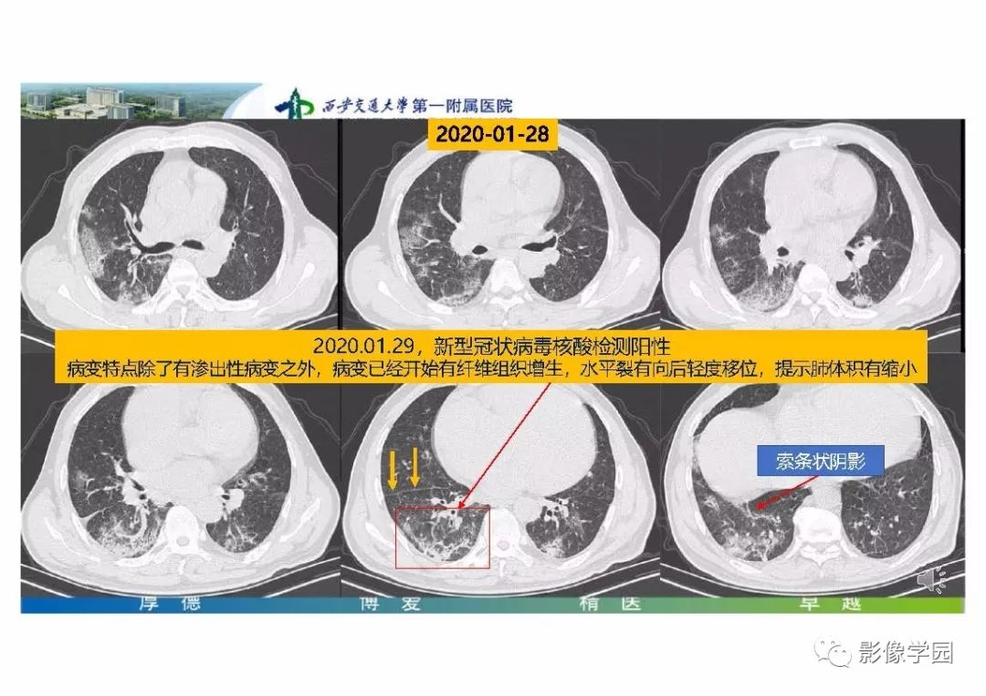 【PPT】输入性新冠肺炎的影像学特点与识别