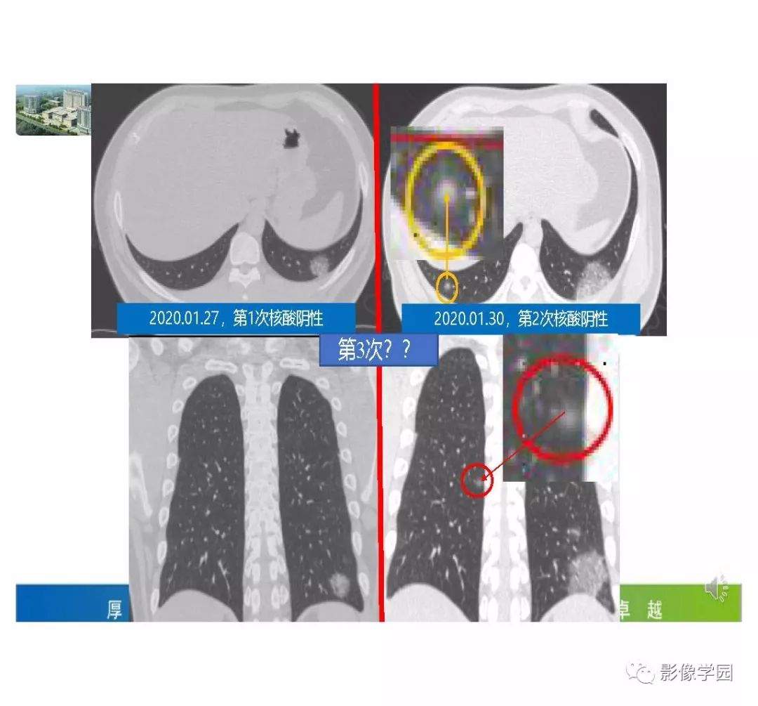 【PPT】输入性新冠肺炎的影像学特点与识别