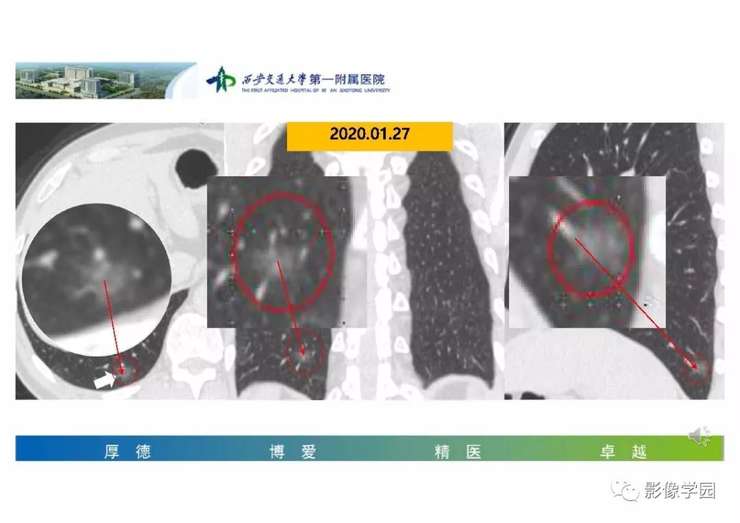 【PPT】输入性新冠肺炎的影像学特点与识别