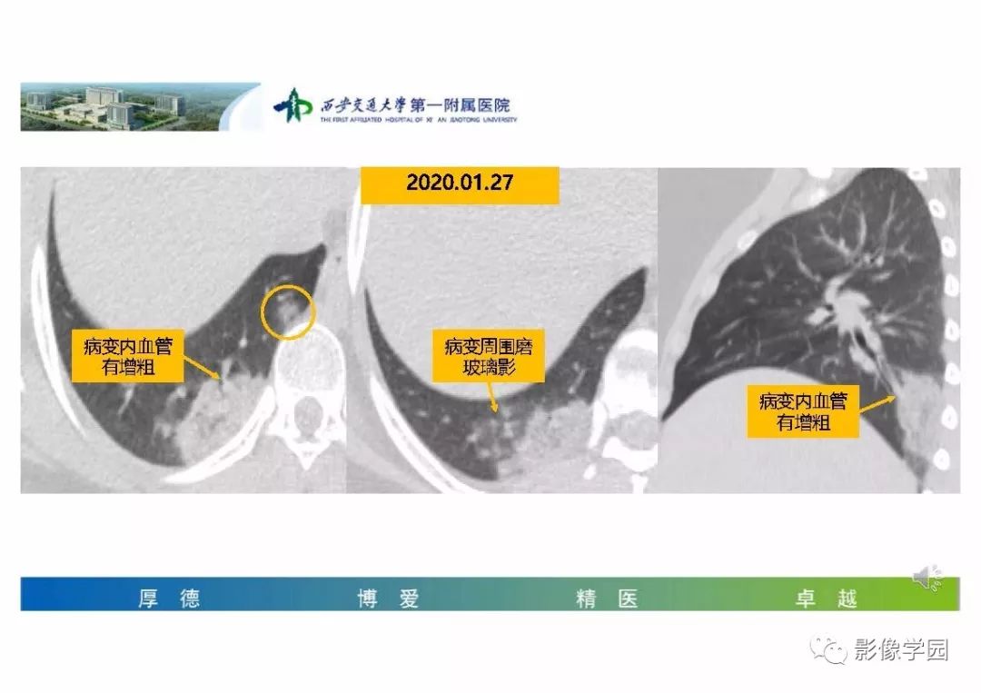 【PPT】输入性新冠肺炎的影像学特点与识别