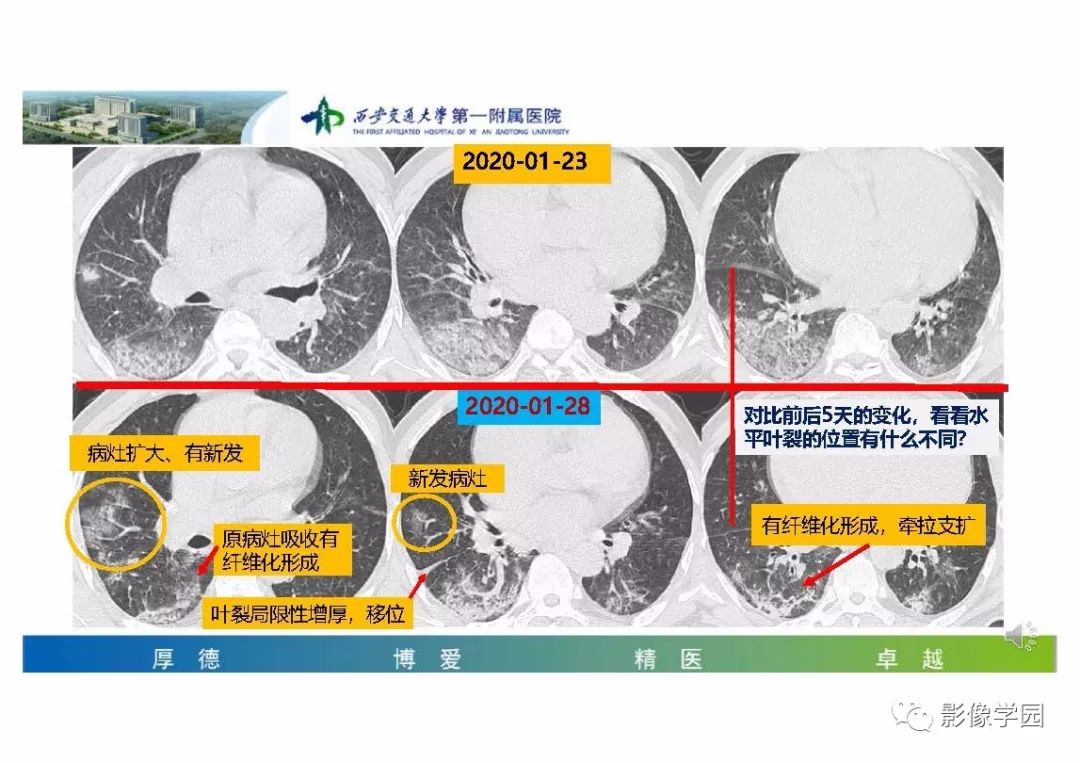 【PPT】输入性新冠肺炎的影像学特点与识别