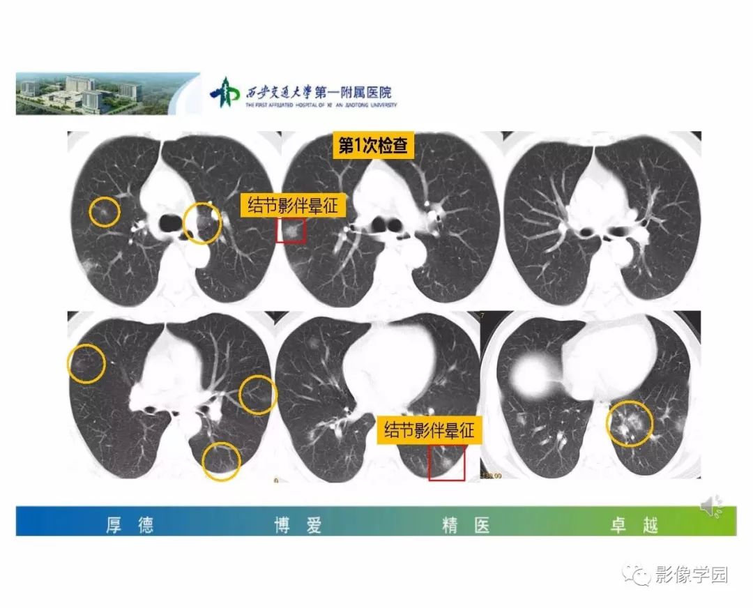 【PPT】输入性新冠肺炎的影像学特点与识别