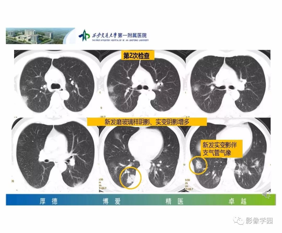 【PPT】输入性新冠肺炎的影像学特点与识别