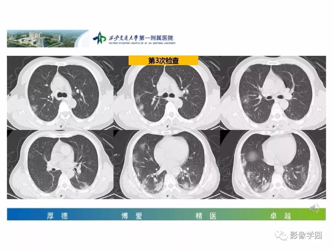 【PPT】输入性新冠肺炎的影像学特点与识别