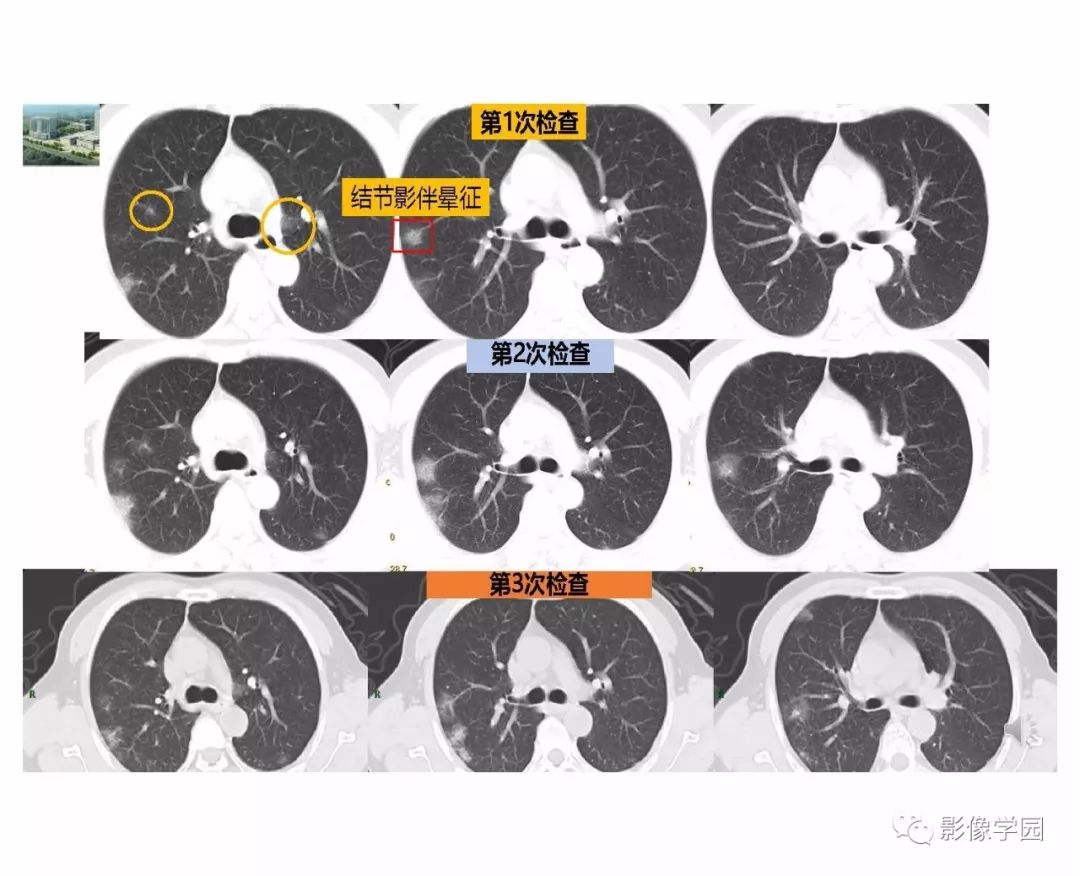 【PPT】输入性新冠肺炎的影像学特点与识别