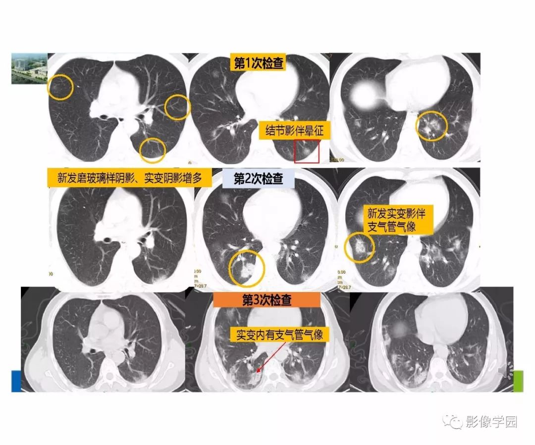 【PPT】输入性新冠肺炎的影像学特点与识别