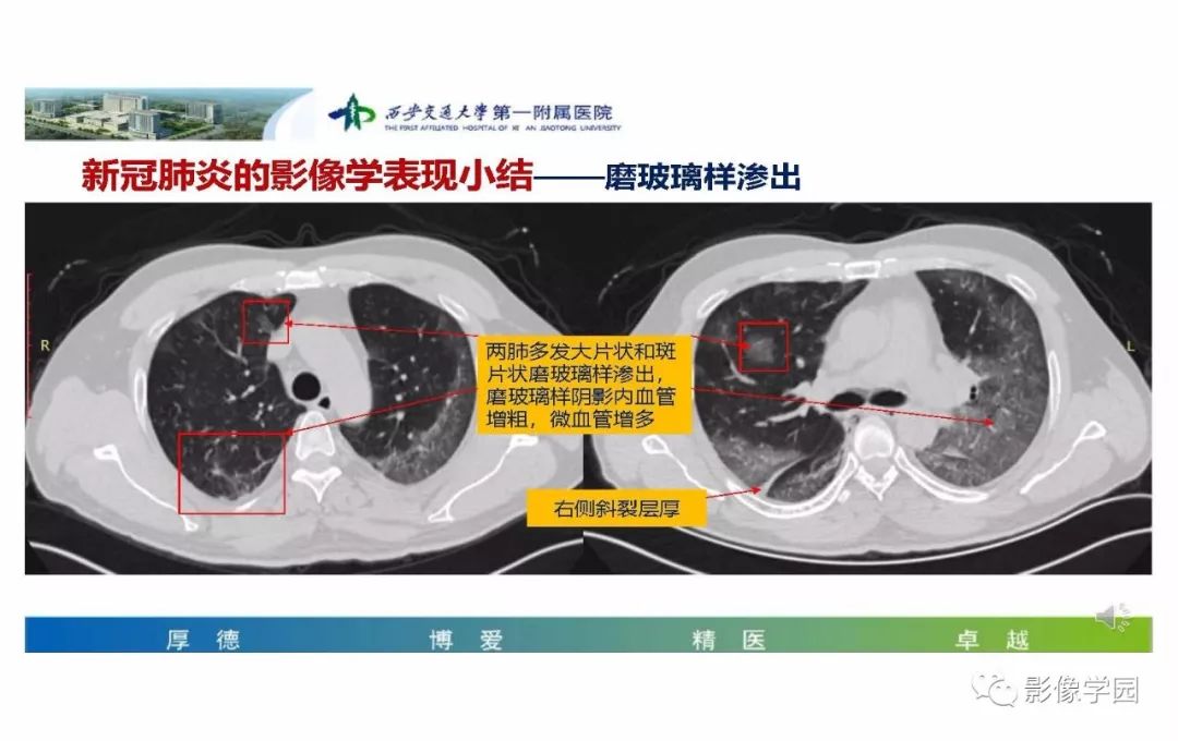 【PPT】输入性新冠肺炎的影像学特点与识别