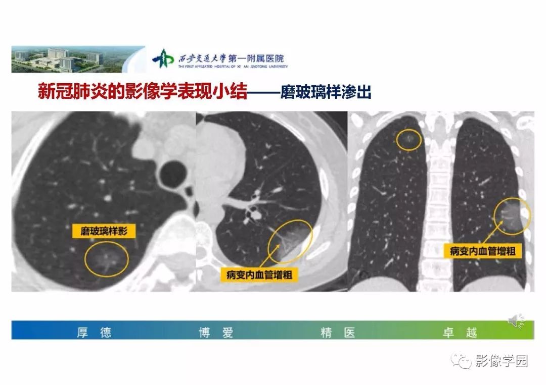 【PPT】输入性新冠肺炎的影像学特点与识别