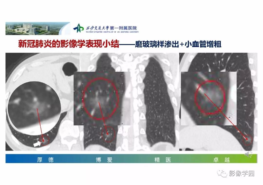 【PPT】输入性新冠肺炎的影像学特点与识别