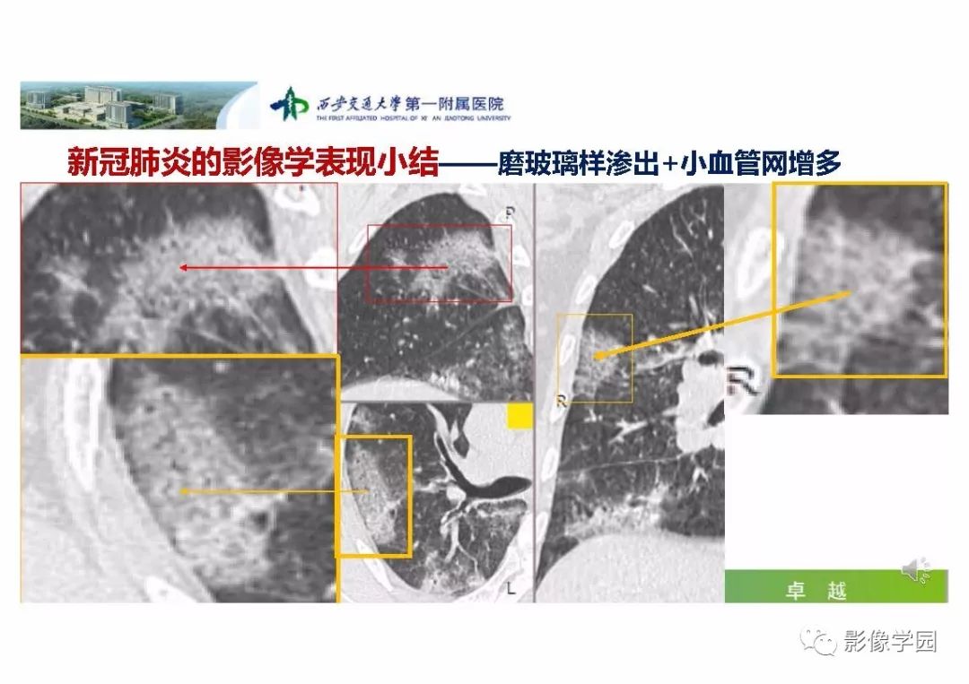 【PPT】输入性新冠肺炎的影像学特点与识别