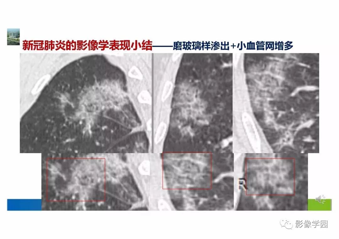 【PPT】输入性新冠肺炎的影像学特点与识别