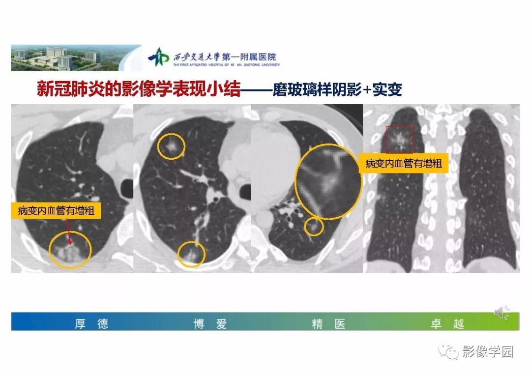【PPT】输入性新冠肺炎的影像学特点与识别