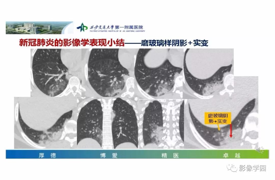 【PPT】输入性新冠肺炎的影像学特点与识别