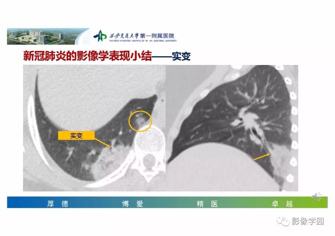 【PPT】输入性新冠肺炎的影像学特点与识别