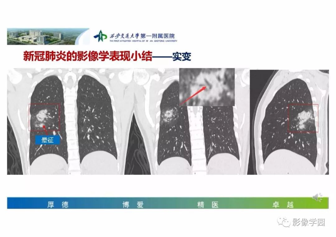 【PPT】输入性新冠肺炎的影像学特点与识别