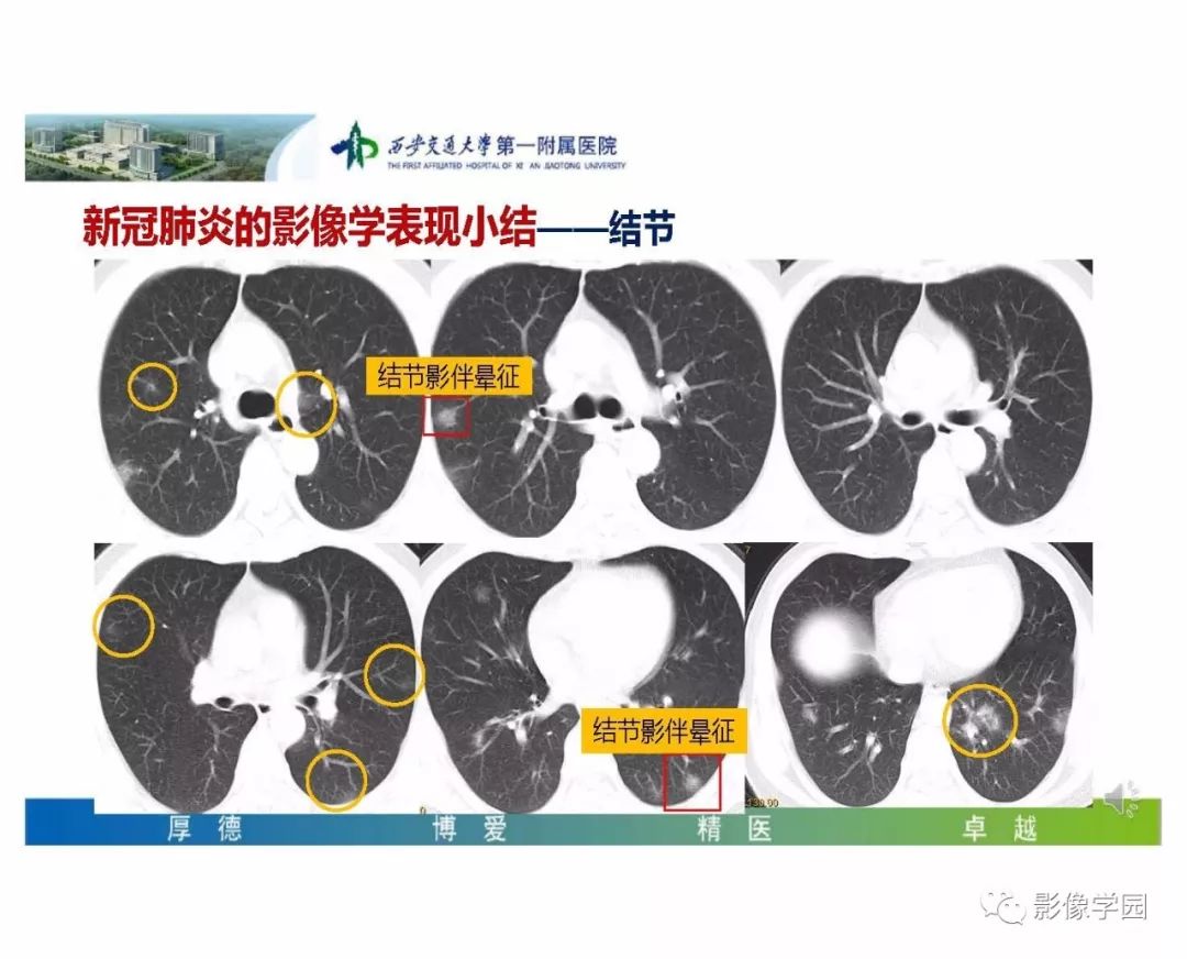 【PPT】输入性新冠肺炎的影像学特点与识别