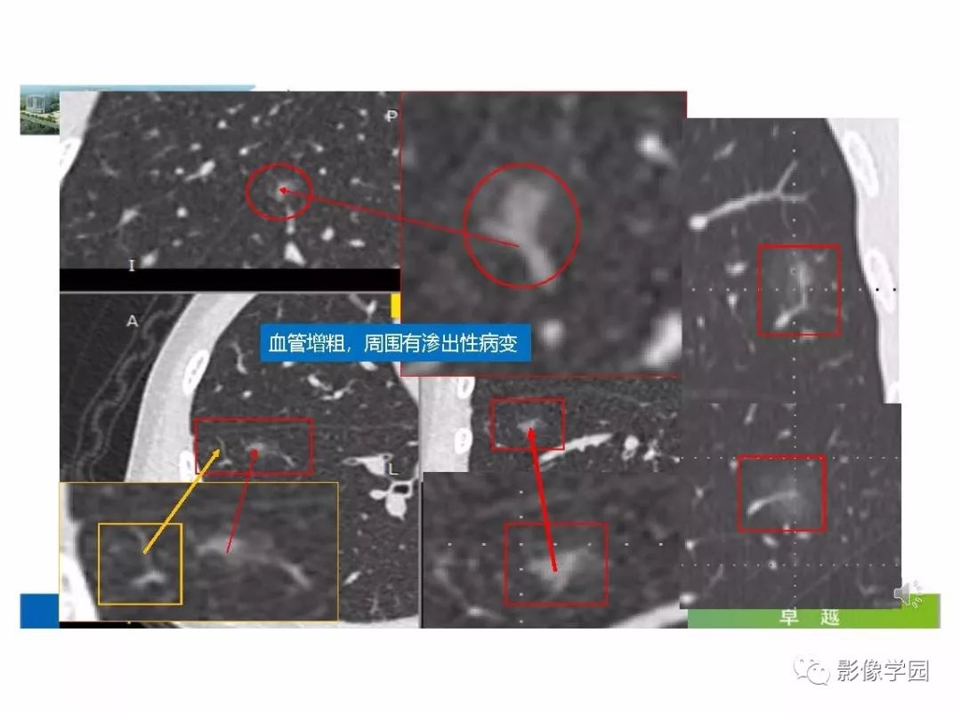 【PPT】输入性新冠肺炎的影像学特点与识别