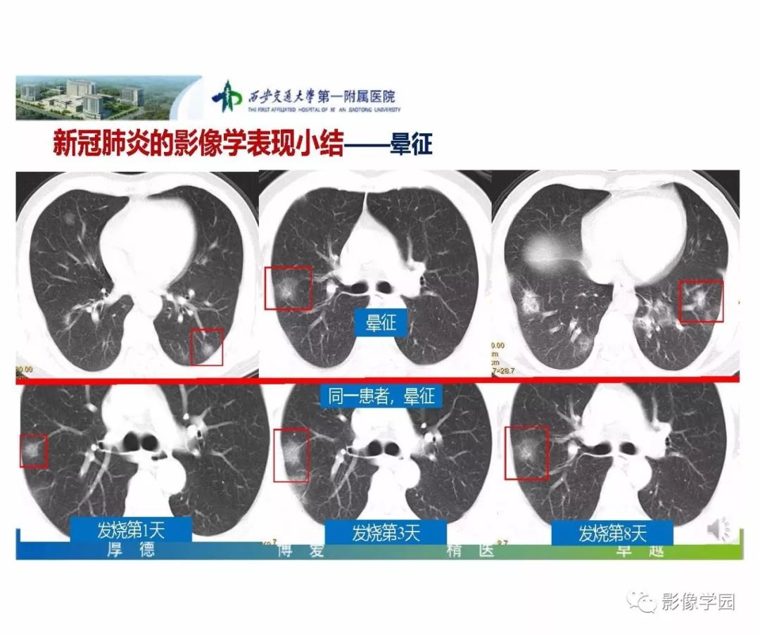 【PPT】输入性新冠肺炎的影像学特点与识别