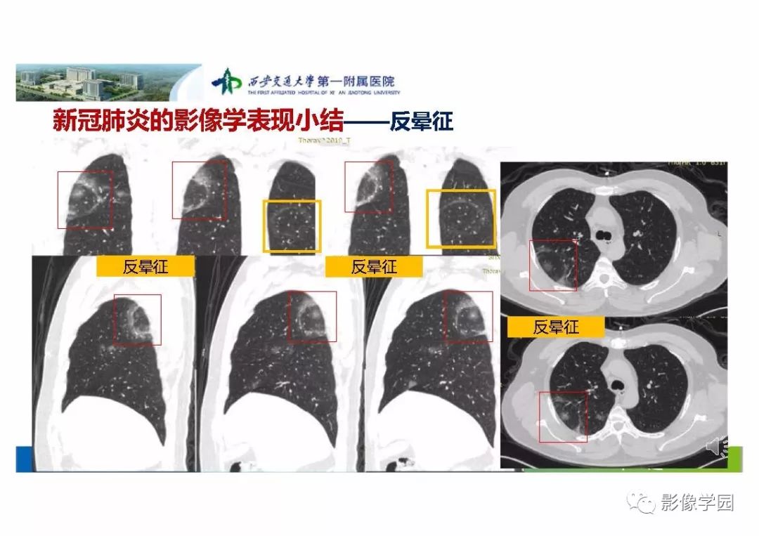 【PPT】输入性新冠肺炎的影像学特点与识别