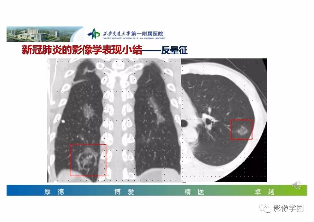 【PPT】输入性新冠肺炎的影像学特点与识别