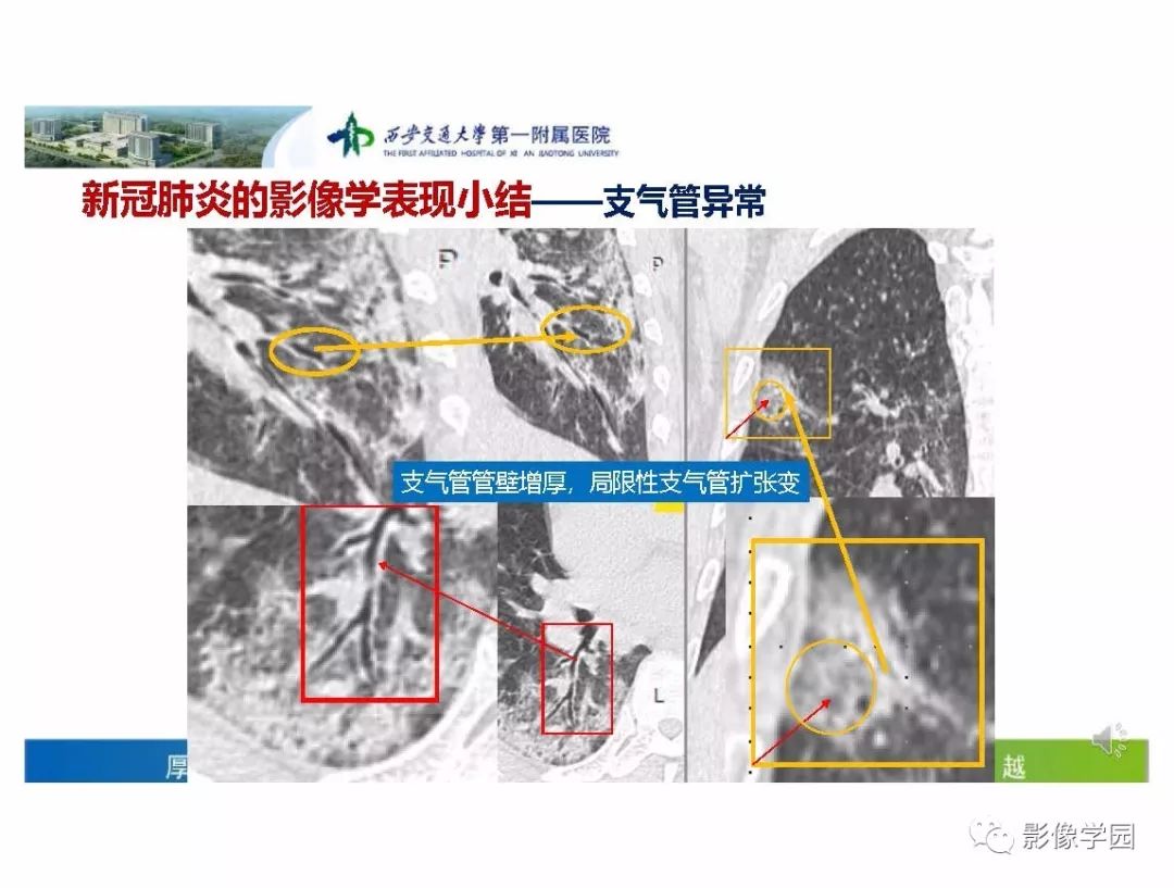 【PPT】输入性新冠肺炎的影像学特点与识别