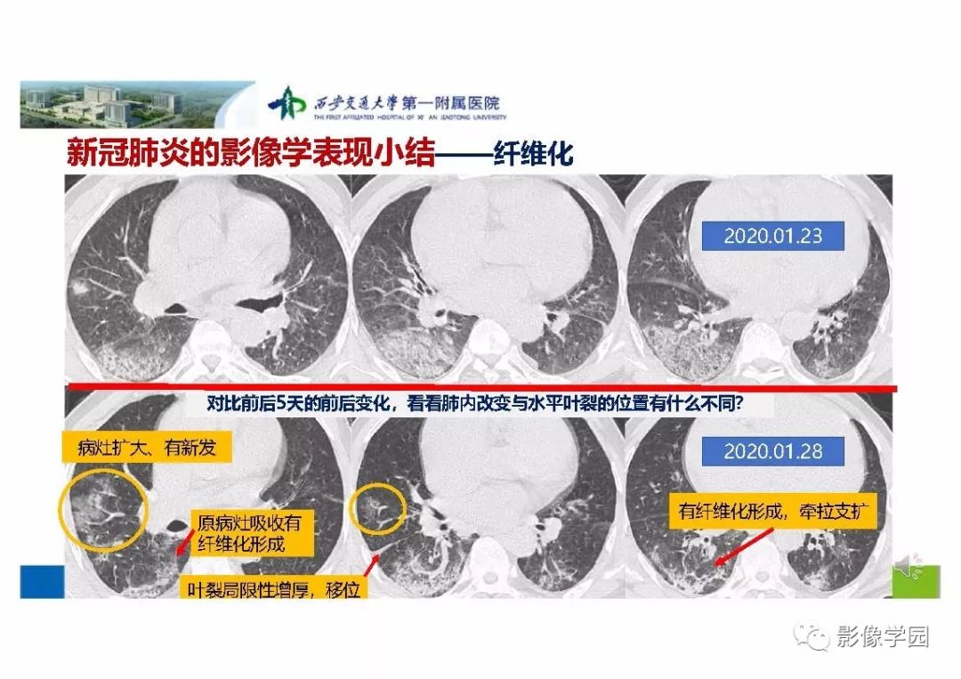 【PPT】输入性新冠肺炎的影像学特点与识别